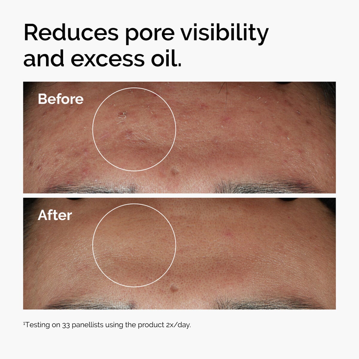 niacinamide-10-zinc-1-k6 ord-niacinamide-zinc-blemish-serum-before-after-pores.jpg