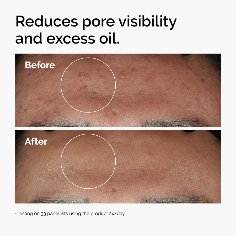 niacinamide-10-zinc-1-k6 ord-niacinamide-zinc-blemish-serum-before-after-pores.jpg