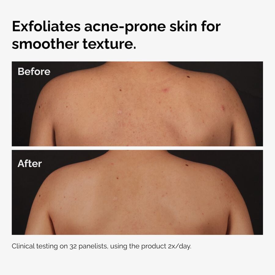 salicylic-acid-0-5-body-serum-n0 ord-salicylic-acid-body-serum-before-after-graphic-NA.jpg
