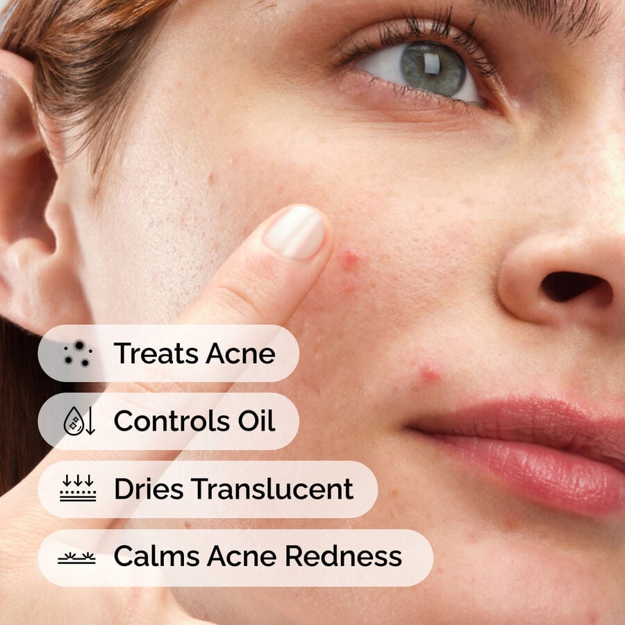 sulfur-10-powder-to-cream-concentrate-a6 ord-sulfur-10pct-powder-to-cream-concentrate-model-application-with-benefits-acne.jpg
